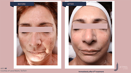 Before and after photos of Jet Peel showing a brighter and clearer skin, a se... [375302]