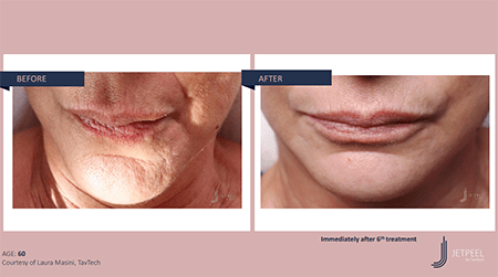 Before and after photos of a woman's lip area from Jet Peel showing a brighte... [58d22b]