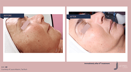 A sideview before and after photos of a woman's face from Jet Peel showing a ... [60b5a7]