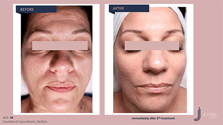 Before and after photos of a woman's face from Jet Peel showing a brighter an... [249666]