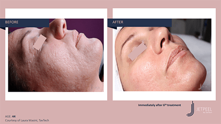 Before and after photos of Jet Peel showing a brighter and clearer skin, a se... [375302]