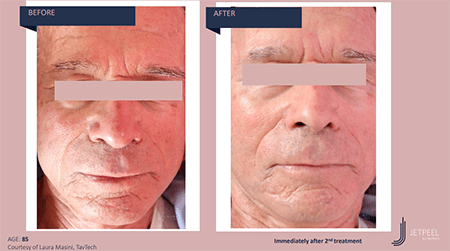 Before and after photos of Jet Peel of a man's face showing a brighter and cl... [47d612]