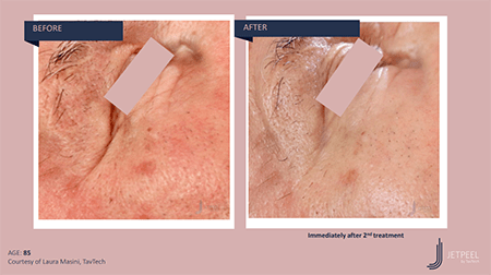 A closeup before and after photos of Jet Peel showing a brighter and clearer ... [7a1028]