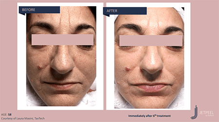 Before and after photos of Jet Peel showing a brighter and clearer skin, a se... [375302]